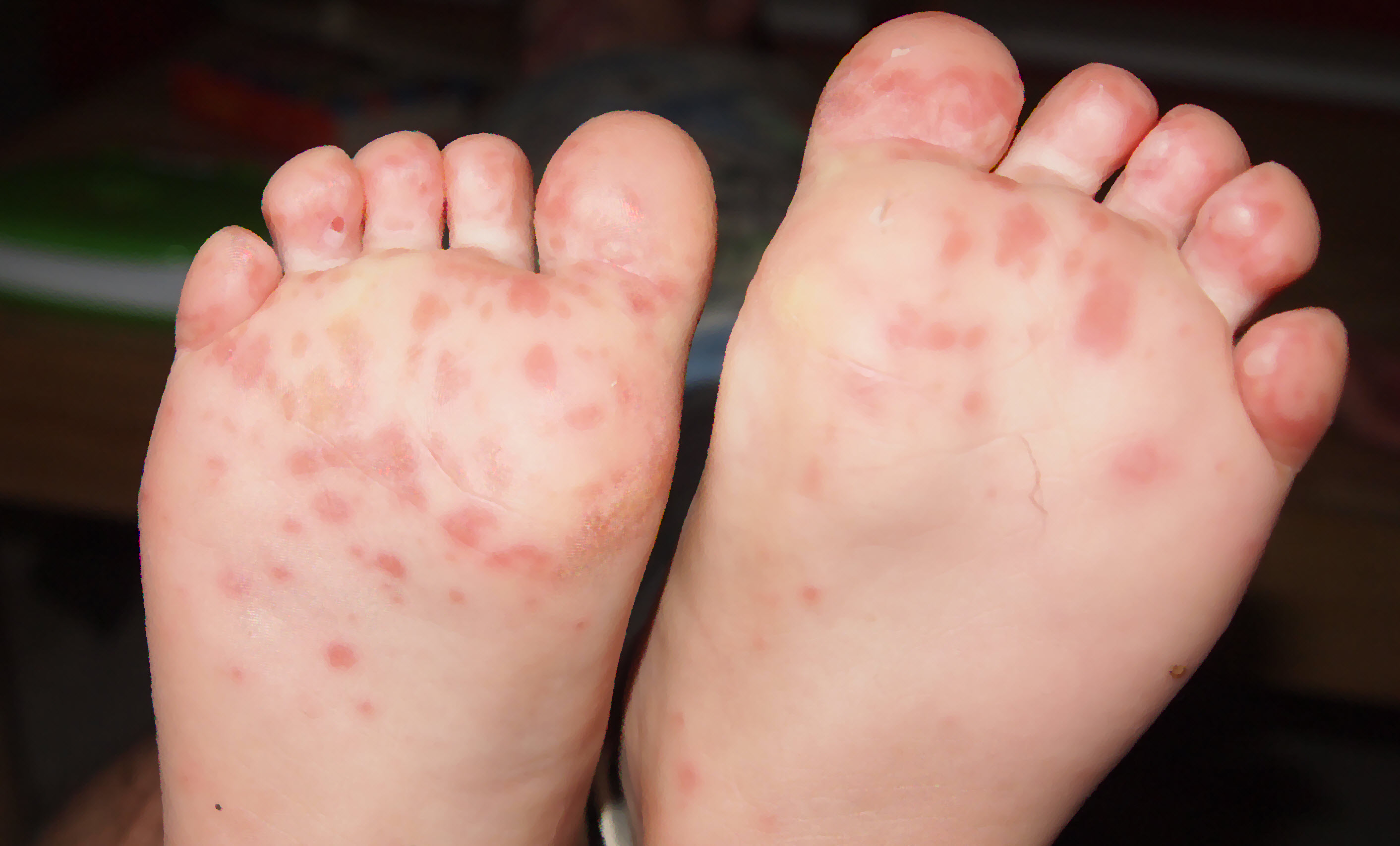 hand,foot,mouth disease